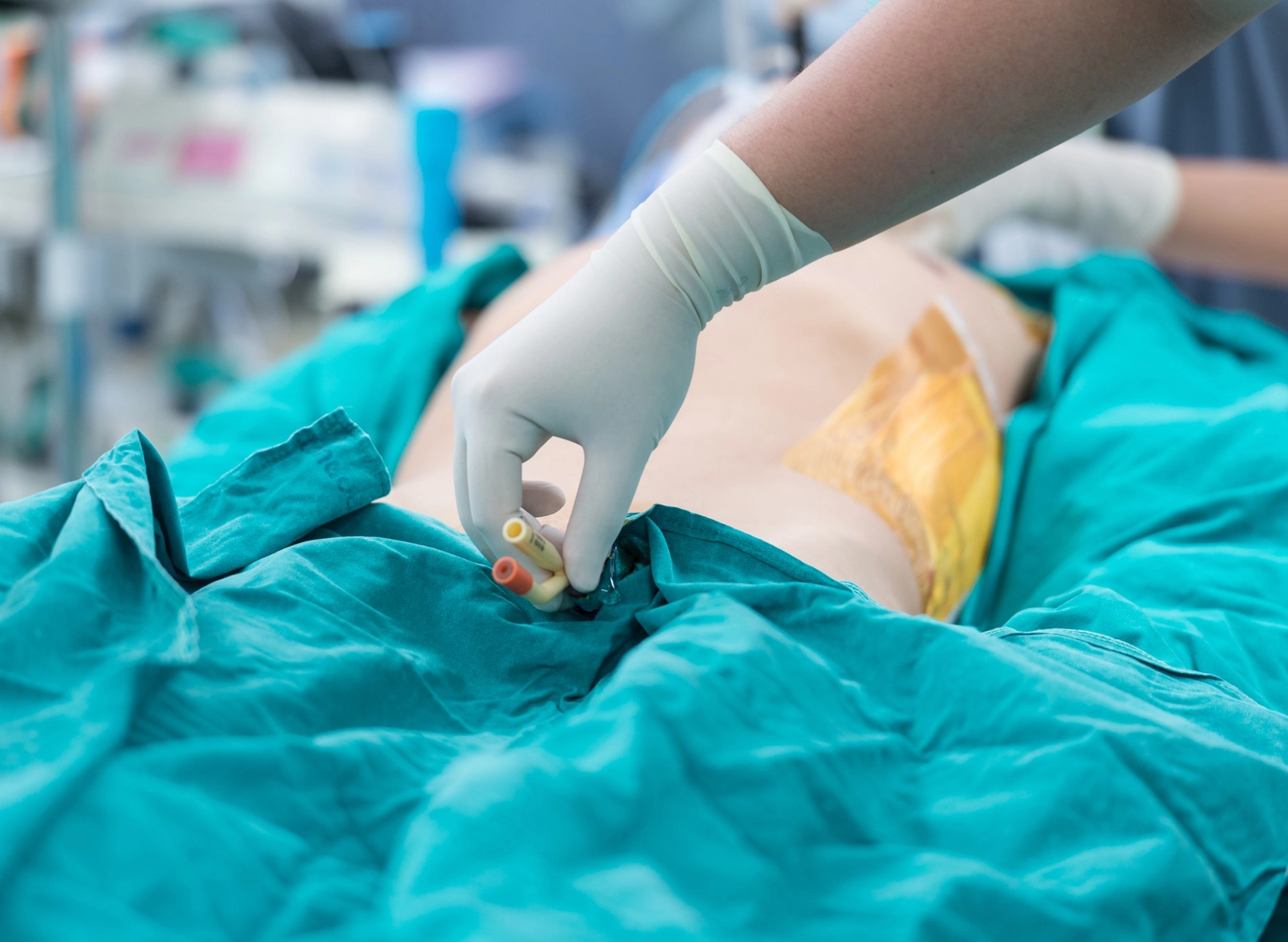 Как установить катетер Как установить катетер