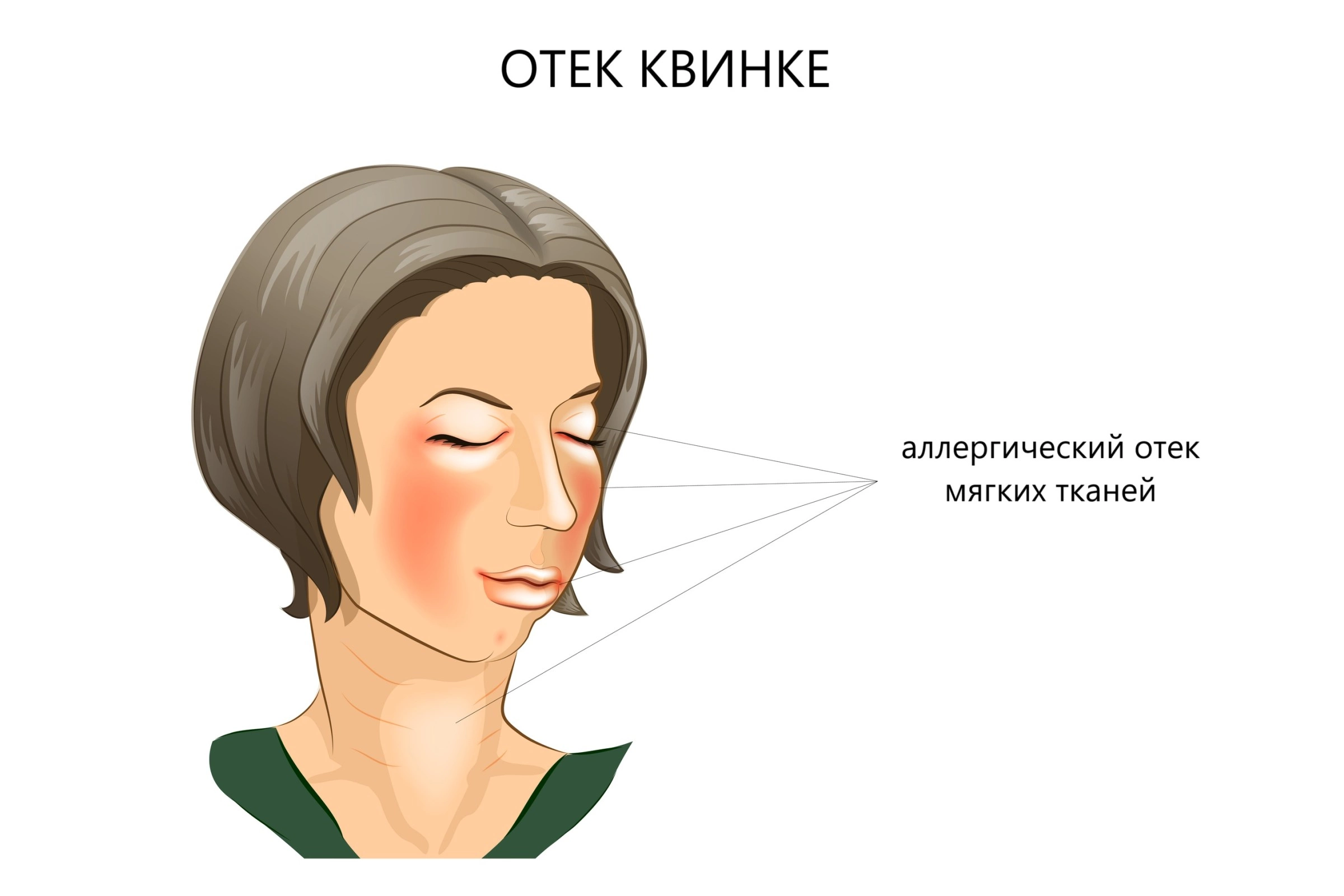 Отек Квинке Отек Квинке